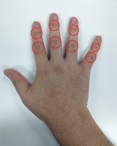 変形性手指関節症